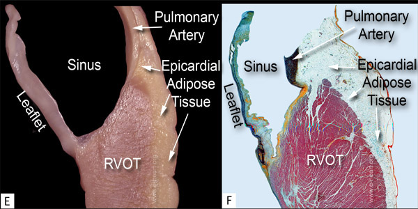 Pulmonic valve gross & Movat